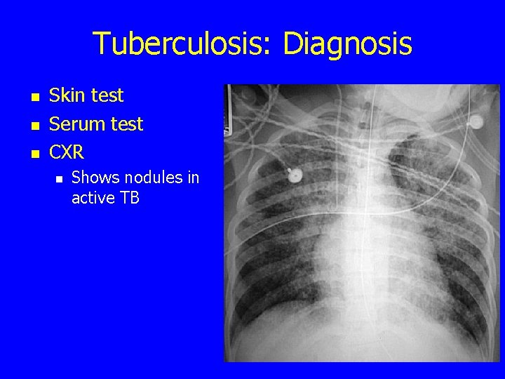 Tuberculosis: Diagnosis n n n Skin test Serum test CXR n Shows nodules in