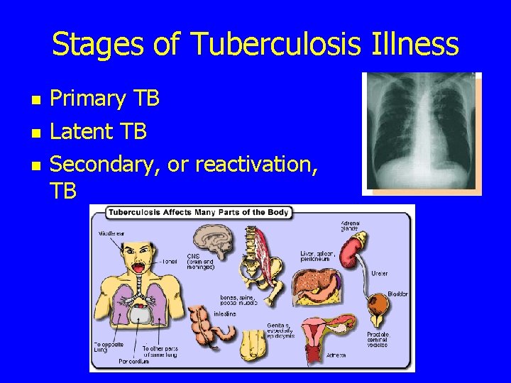 Stages of Tuberculosis Illness n n n Primary TB Latent TB Secondary, or reactivation,