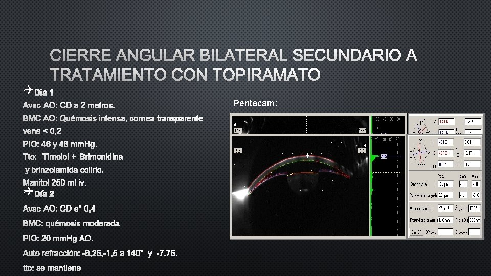 CIERRE ANGULAR BILATERAL SECUNDARIO A TRATAMIENTO CON TOPIRAMATO Q DIA 1 Pentacam: AVSC AO: CIERRE ANGULAR BILATERAL SECUNDARIO A TRATAMIENTO CON TOPIRAMATO Q DIA 1 Pentacam: AVSC AO: