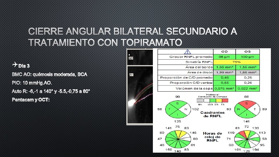 CIERRE ANGULAR BILATERAL SECUNDARIO A TRATAMIENTO CON TOPIRAMATO Q DIA 3 BMC AO: QUÉMOSIS CIERRE ANGULAR BILATERAL SECUNDARIO A TRATAMIENTO CON TOPIRAMATO Q DIA 3 BMC AO: QUÉMOSIS