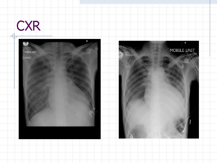 CXR 