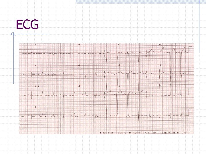 ECG 