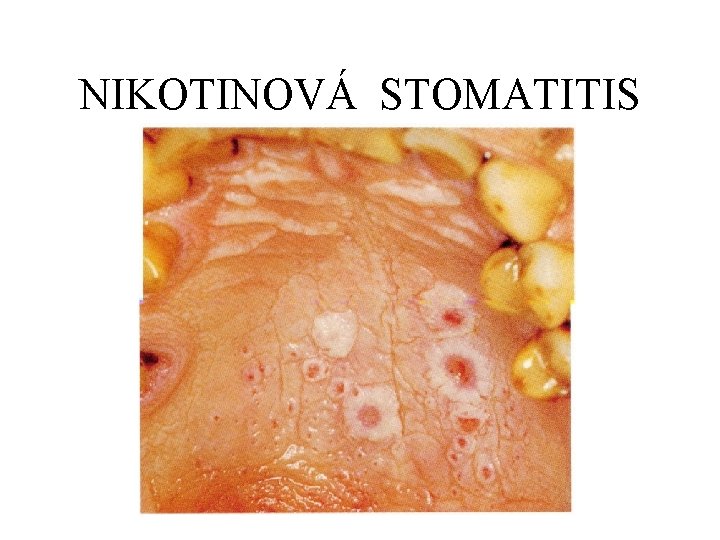 NIKOTINOVÁ STOMATITIS 