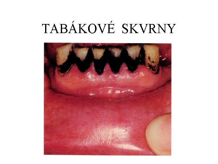 TABÁKOVÉ SKVRNY 