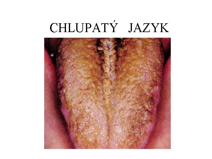 CHLUPATÝ JAZYK 