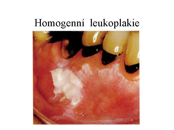 Homogenní leukoplakie 