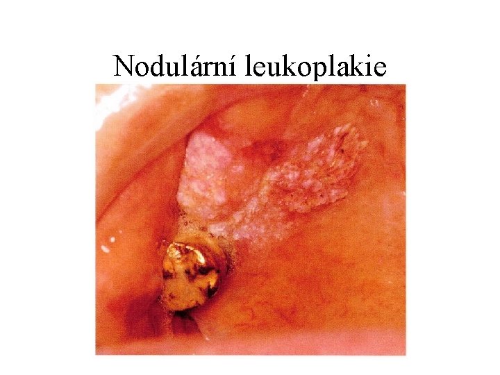 Nodulární leukoplakie 