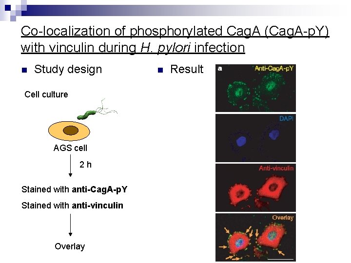 Co-localization of phosphorylated Cag. A (Cag. A-p. Y) with vinculin during H. pylori infection