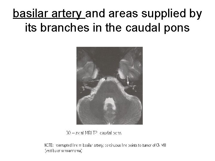 basilar artery and areas supplied by its branches in the caudal pons 