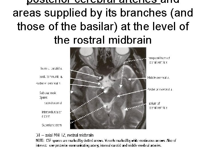 posterior cerebral arteries and areas supplied by its branches (and those of the basilar)