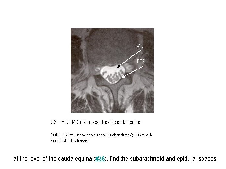 at the level of the cauda equina (#36), find the subarachnoid and epidural spaces