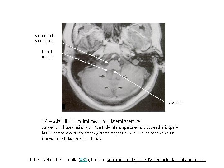 at the level of the medulla (#32), find the subarachnoid space, IV ventricle, lateral