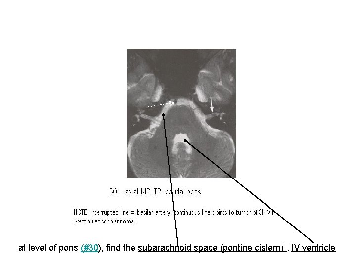 at level of pons (#30), find the subarachnoid space (pontine cistern) , IV ventricle