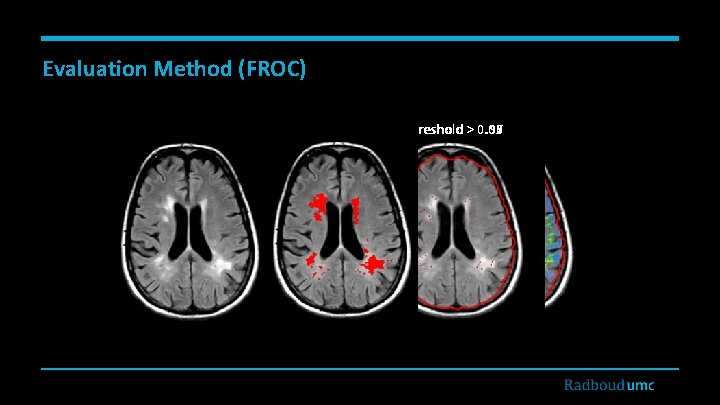 Evaluation Method (FROC) Threshold > 0. 00 0. 99 0. 97 0. 95 FLAIR