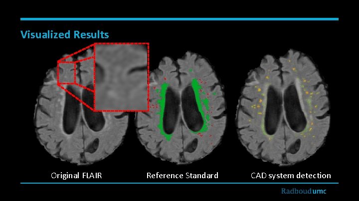 Visualized Results Original FLAIR Reference Standard CAD system detection 