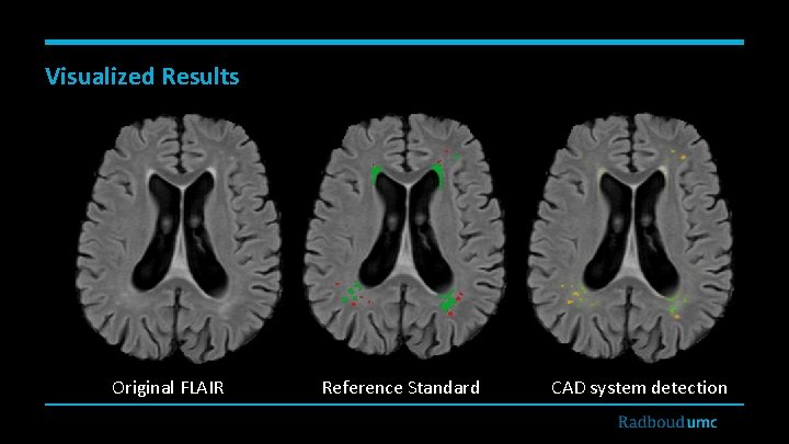 Visualized Results Original FLAIR Reference Standard CAD system detection 