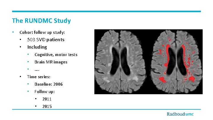 The RUNDMC Study • Cohort follow up study: • • • 503 SVD patients