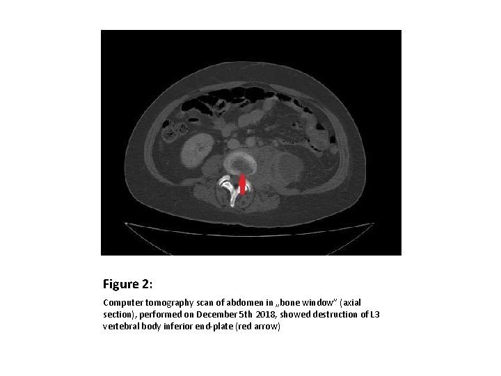 Figure 2: Computer tomography scan of abdomen in „bone window” (axial section), performed on