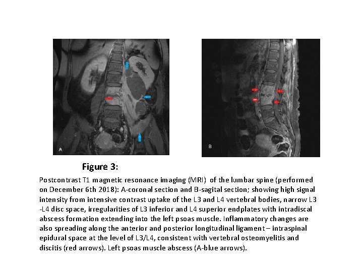 Figure 3: Postcontrast T 1 magnetic resonance imaging (MRI) of the lumbar spine (performed