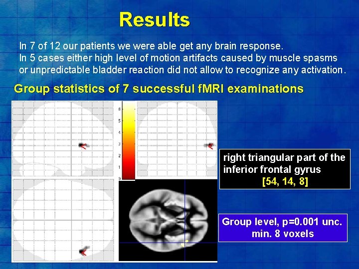 Results In 7 of 12 our patients we were able get any brain response.