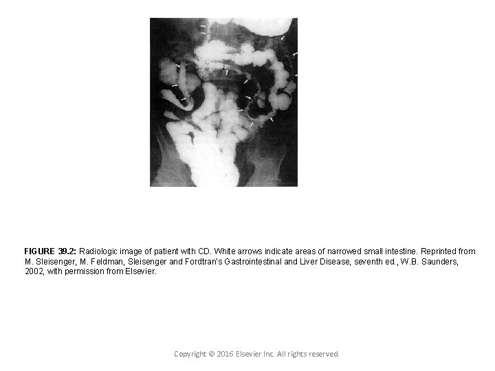 FIGURE 39. 2: Radiologic image of patient with CD. White arrows indicate areas of