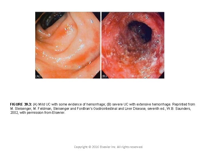 FIGURE 39. 3: (A) Mild UC with some evidence of hemorrhage; (B) severe UC