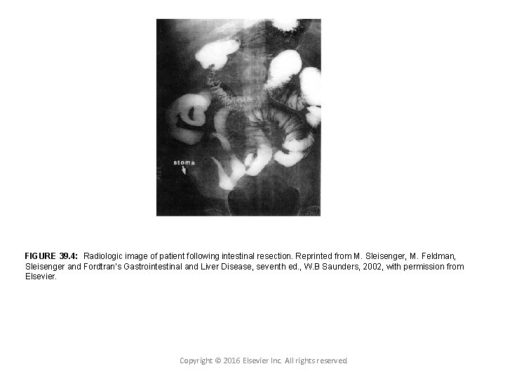 FIGURE 39. 4: Radiologic image of patient following intestinal resection. Reprinted from M. Sleisenger,