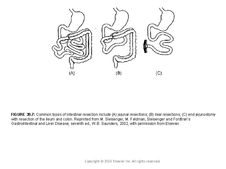 FIGURE 39. 7: Common types of intestinal resection include (A) jejunal resections; (B) ileal