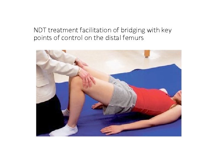 NDT treatment facilitation of bridging with key points of control on the distal femurs