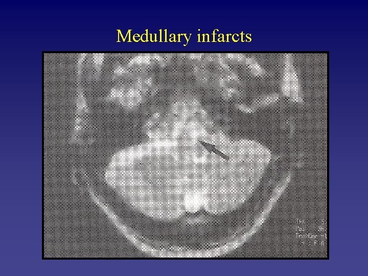 Medullary infarcts 