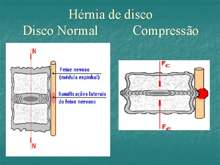 Hérnia de disco Disco Normal Compressão 