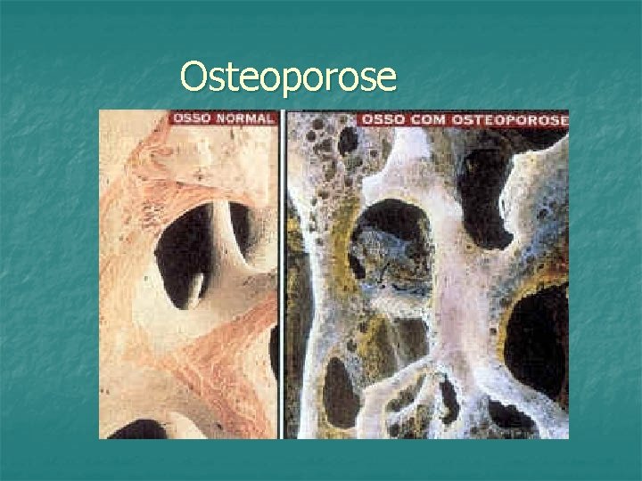 Osteoporose 