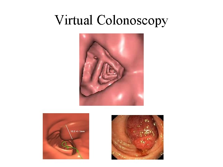 Virtual Colonoscopy 