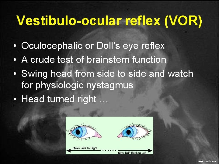 Vestibulo-ocular reflex (VOR) • Oculocephalic or Doll’s eye reflex • A crude test of Vestibulo-ocular reflex (VOR) • Oculocephalic or Doll’s eye reflex • A crude test of