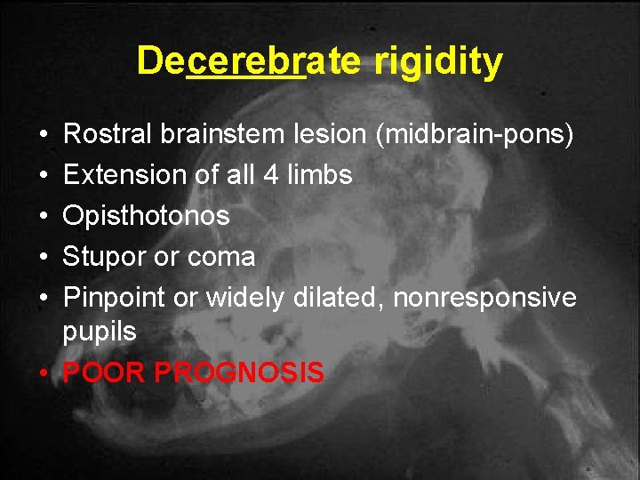 Decerebrate rigidity • • • Rostral brainstem lesion (midbrain-pons) Extension of all 4 limbs Decerebrate rigidity • • • Rostral brainstem lesion (midbrain-pons) Extension of all 4 limbs