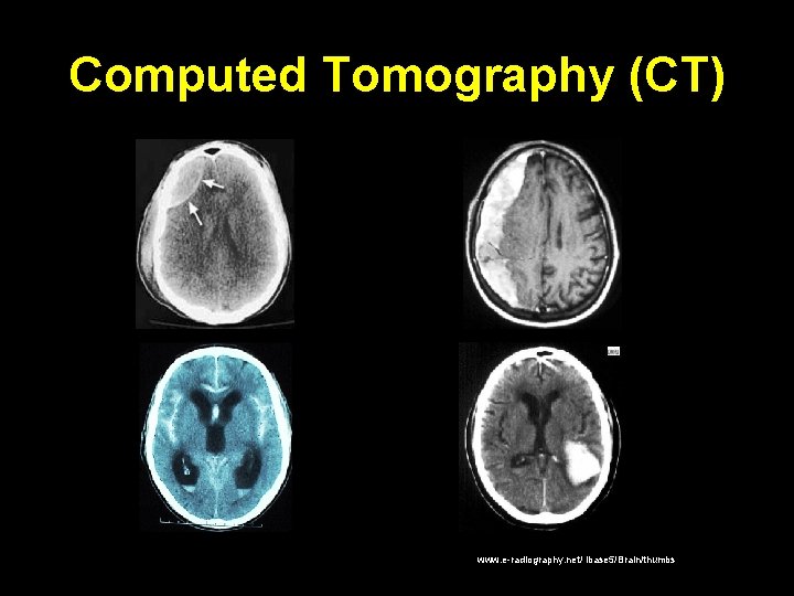 Computed Tomography (CT) www. e-radiography. net/ ibase 5/Brain/thumbs Computed Tomography (CT) www. e-radiography. net/ ibase 5/Brain/thumbs