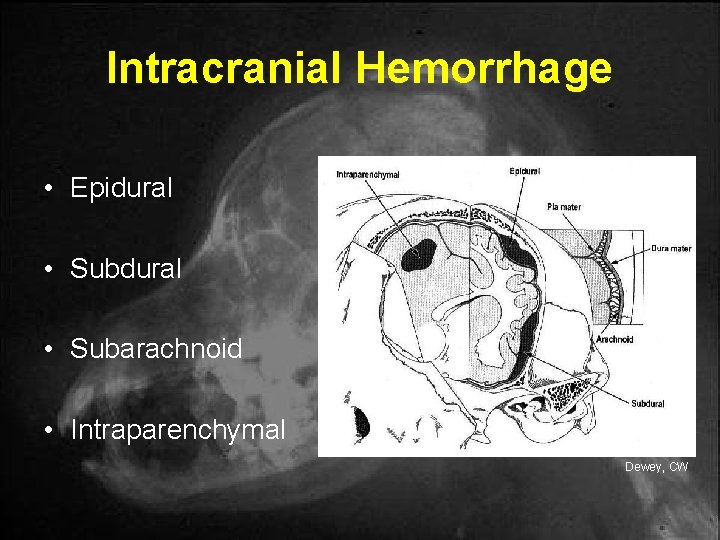 Intracranial Hemorrhage • Epidural • Subarachnoid • Intraparenchymal Dewey, CW Intracranial Hemorrhage • Epidural • Subarachnoid • Intraparenchymal Dewey, CW