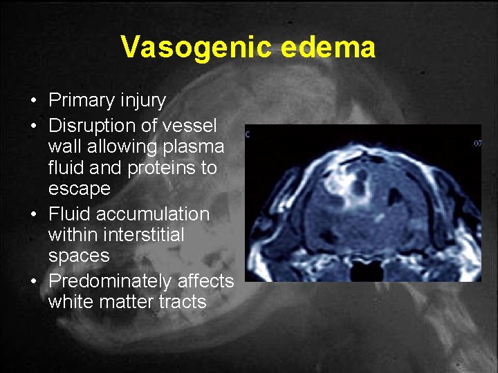 Vasogenic edema • Primary injury • Disruption of vessel wall allowing plasma fluid and Vasogenic edema • Primary injury • Disruption of vessel wall allowing plasma fluid and