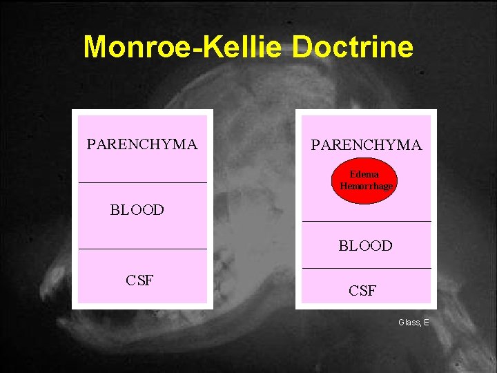 Monroe-Kellie Doctrine PARENCHYMA Edema Hemorrhage BLOOD CSF Glass, E Monroe-Kellie Doctrine PARENCHYMA Edema Hemorrhage BLOOD CSF Glass, E