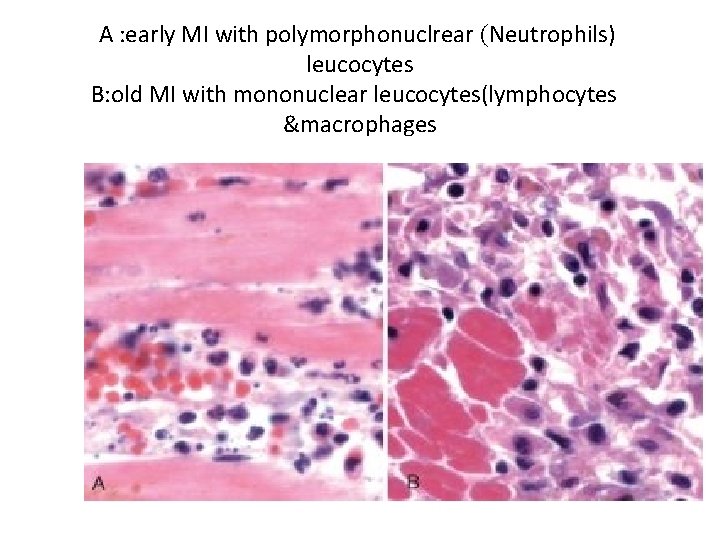 A : early MI with polymorphonuclrear (Neutrophils) leucocytes B: old MI with mononuclear leucocytes(lymphocytes