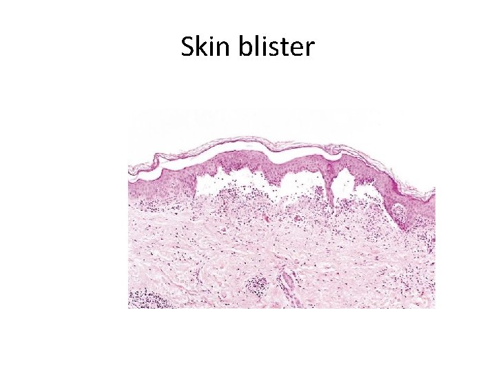 Skin blister 
