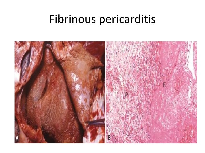 Fibrinous pericarditis 