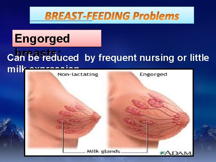 Engorged breasts; breasts Can be reduced milk expression. by frequent nursing or little 