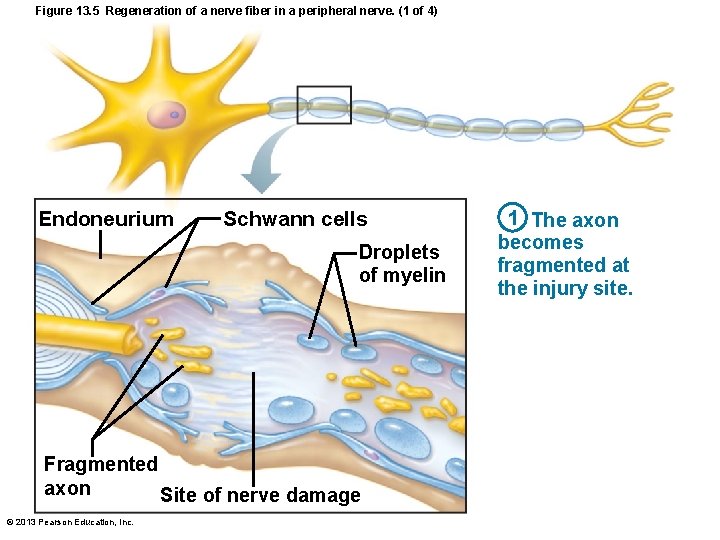 Figure 13. 5 Regeneration of a nerve fiber in a peripheral nerve. (1 of