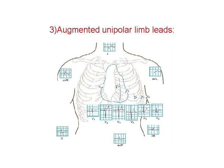 3)Augmented unipolar limb leads: 