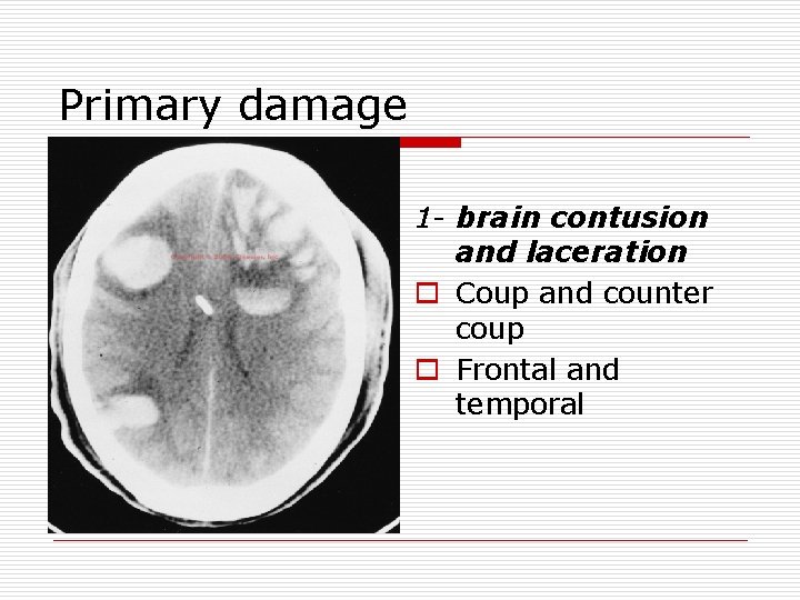 Primary damage 1 - brain contusion and laceration o Coup and counter coup o