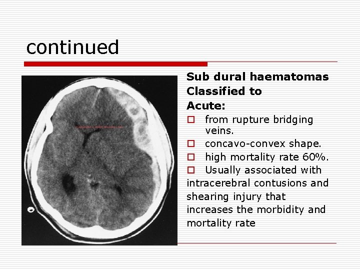 continued Sub dural haematomas Classified to Acute: o from rupture bridging veins. o concavo-convex