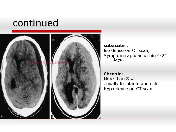 continued subacute : Iso dense on CT scan, Symptoms appear within 4 -21 days.