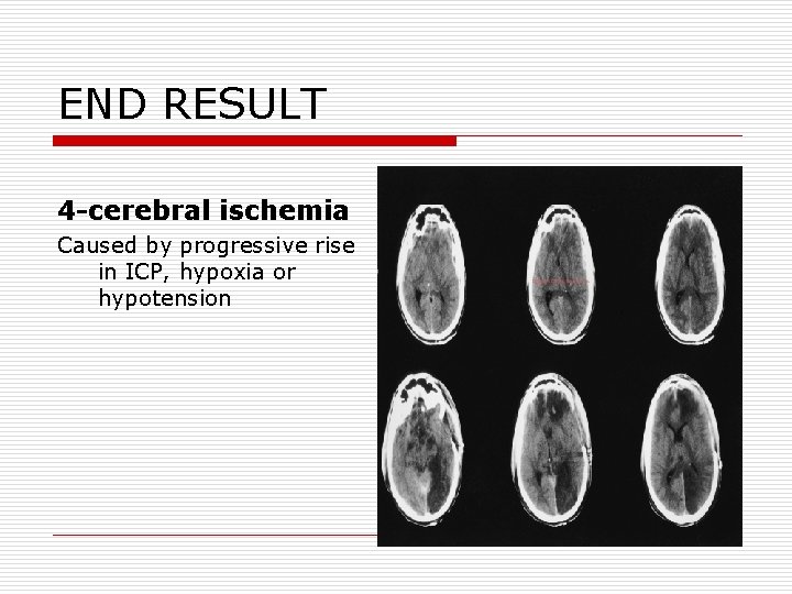 END RESULT 4 -cerebral ischemia Caused by progressive rise in ICP, hypoxia or hypotension