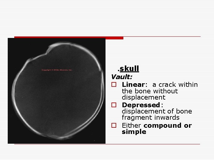 . skull Vault: o Linear: a crack within the bone without displacement o Depressed: